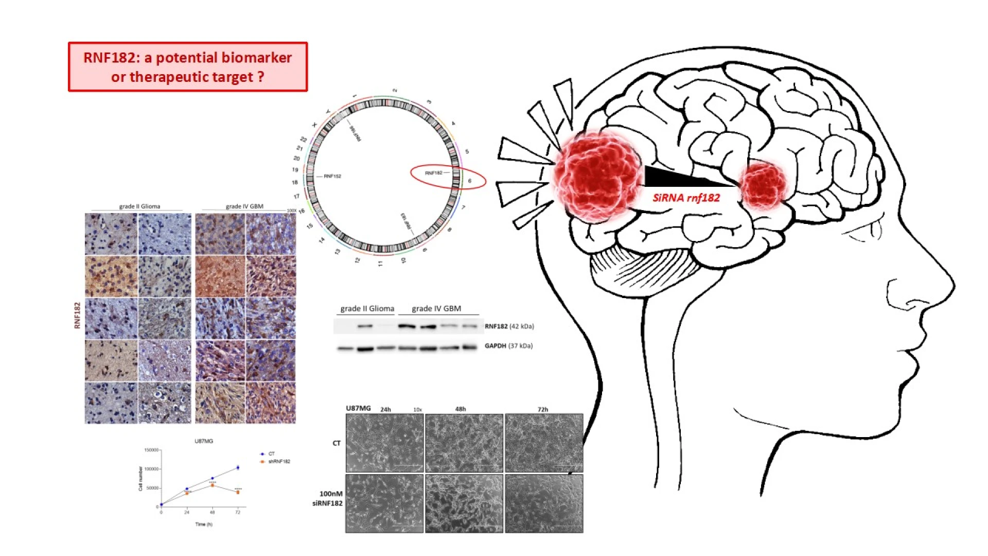 Una proteina implicata nei meccanismi di regolazione cellulare è associata ai tumori cerebrali più aggressivi